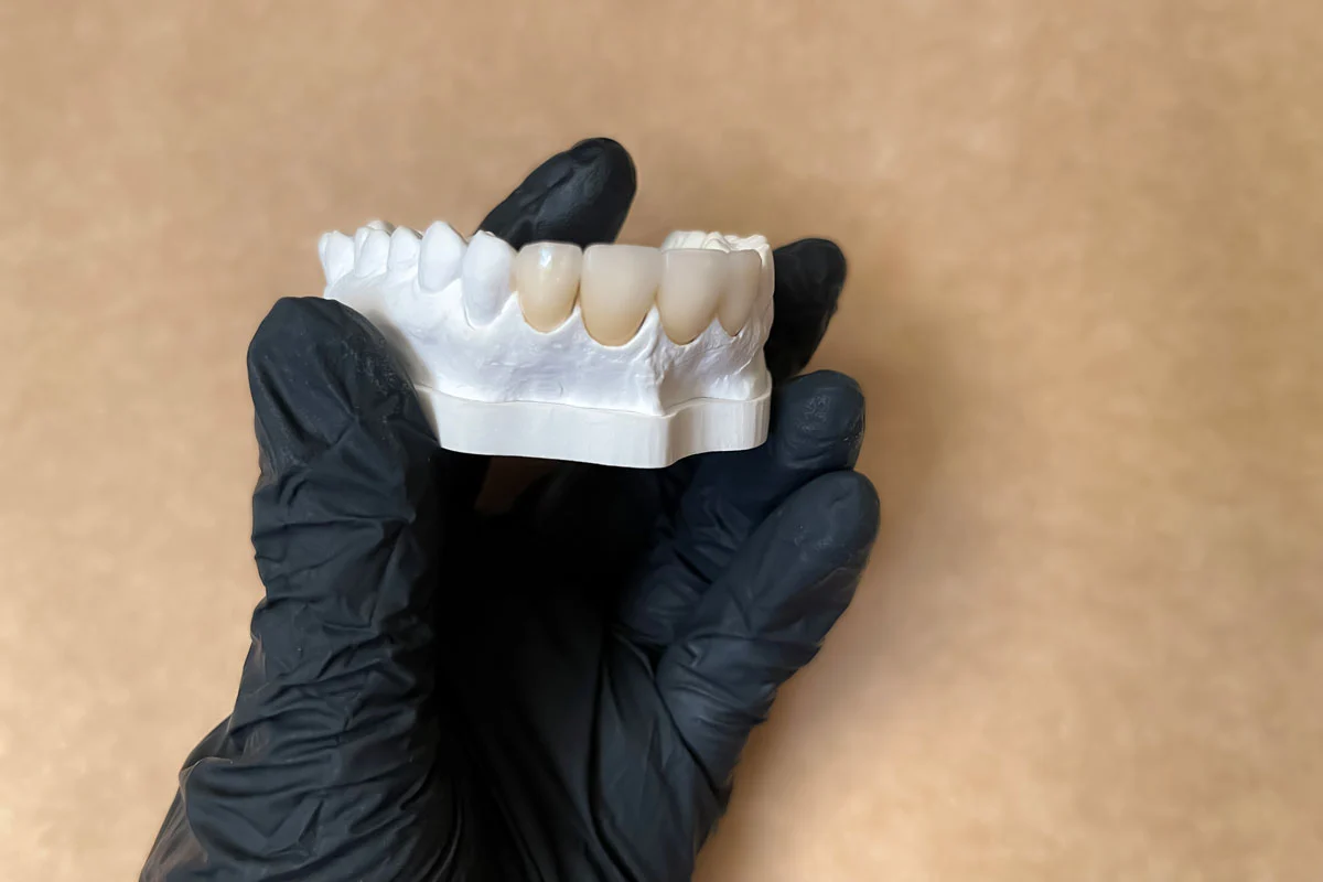 Coroana pe structură de zirconiu cu ceramică