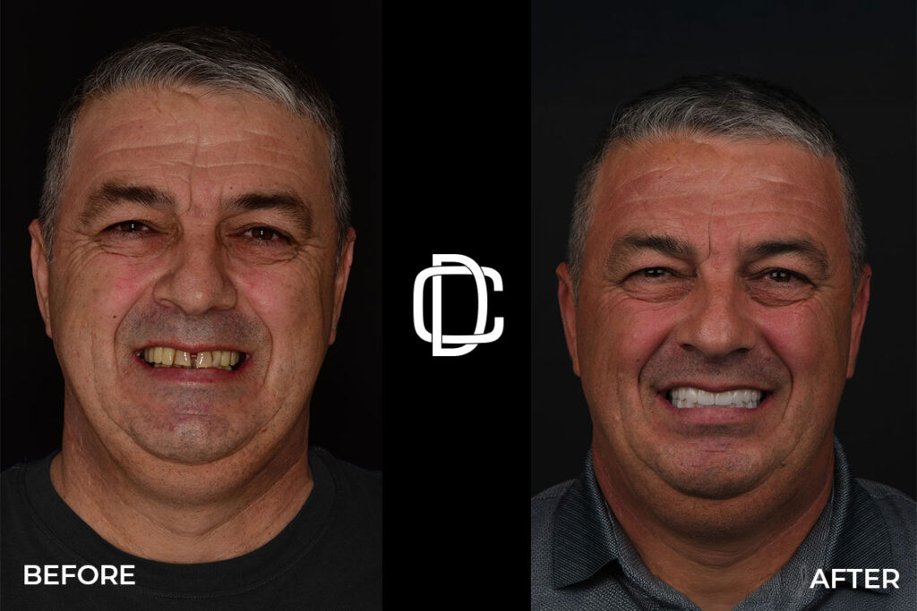 caz before and after dinti ficsi