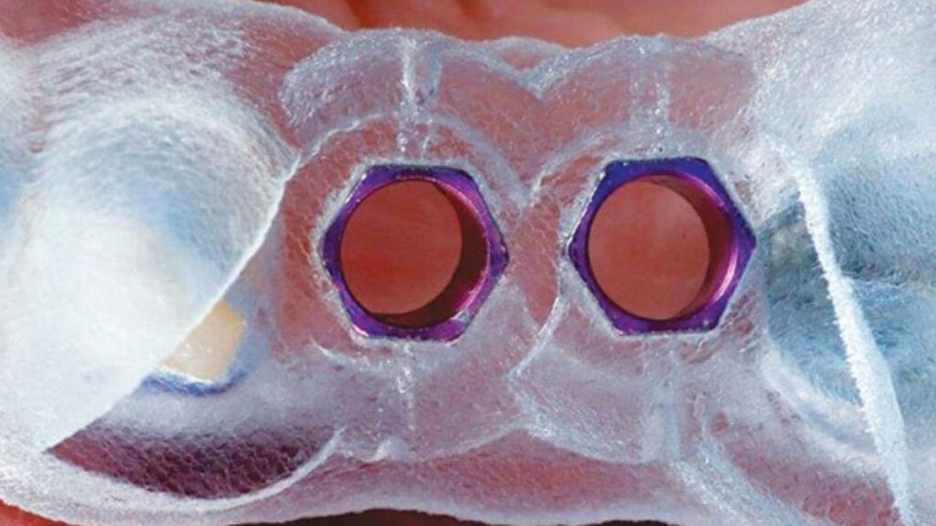 procedura de implant dentar ghidat digital