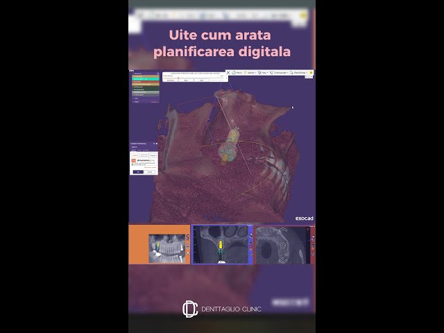 Implant dentar planificat digital