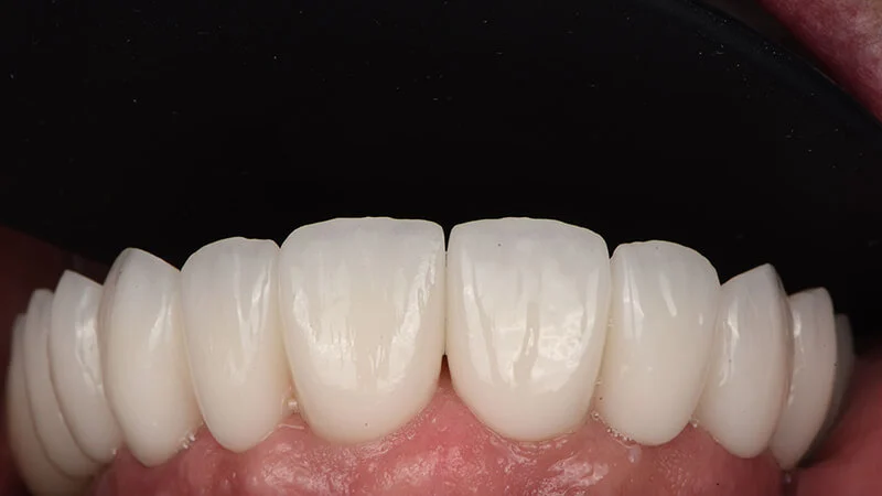 Tipuri de lucrări dentare