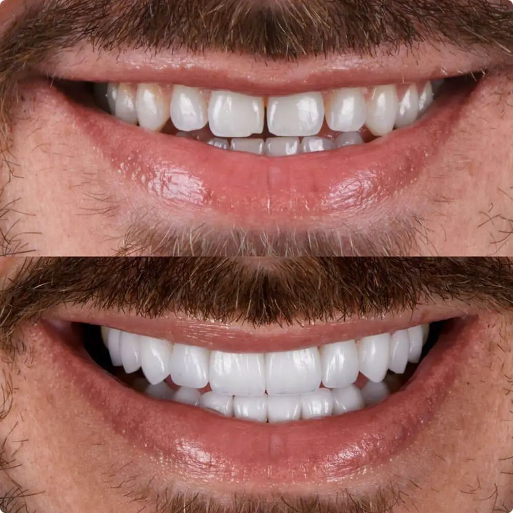 before and after fatete dentare la Denttaglio