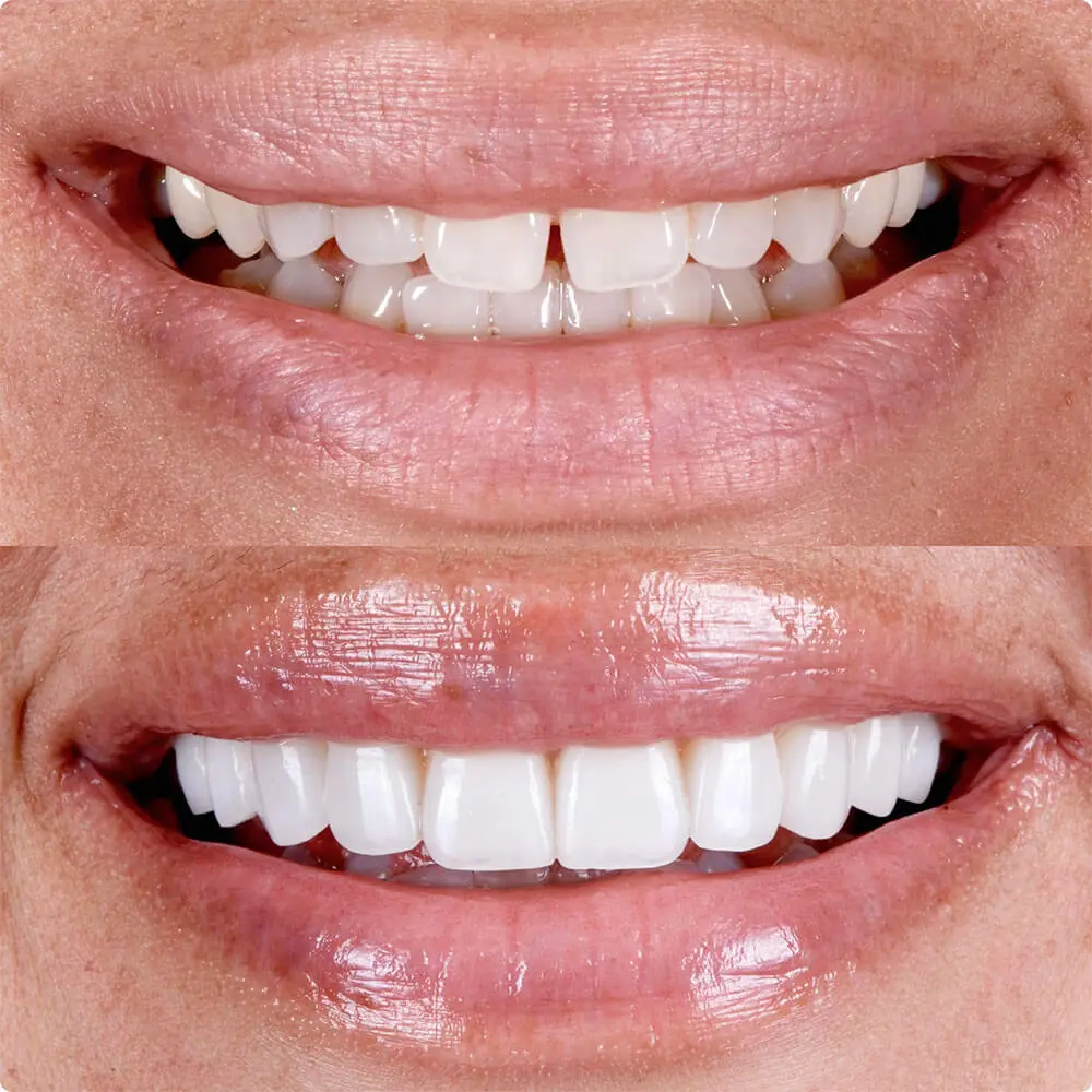 before and after fatete dentare la Denttaglio