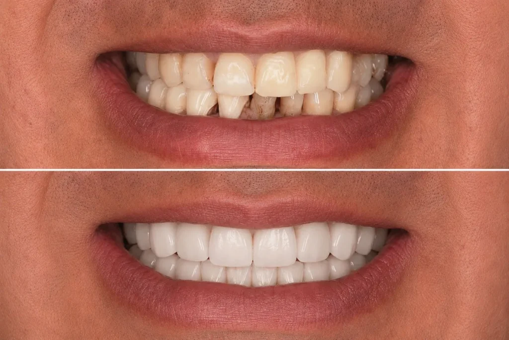 Caz clinic reabilitare dentară completă pe implanturi - Denttaglio