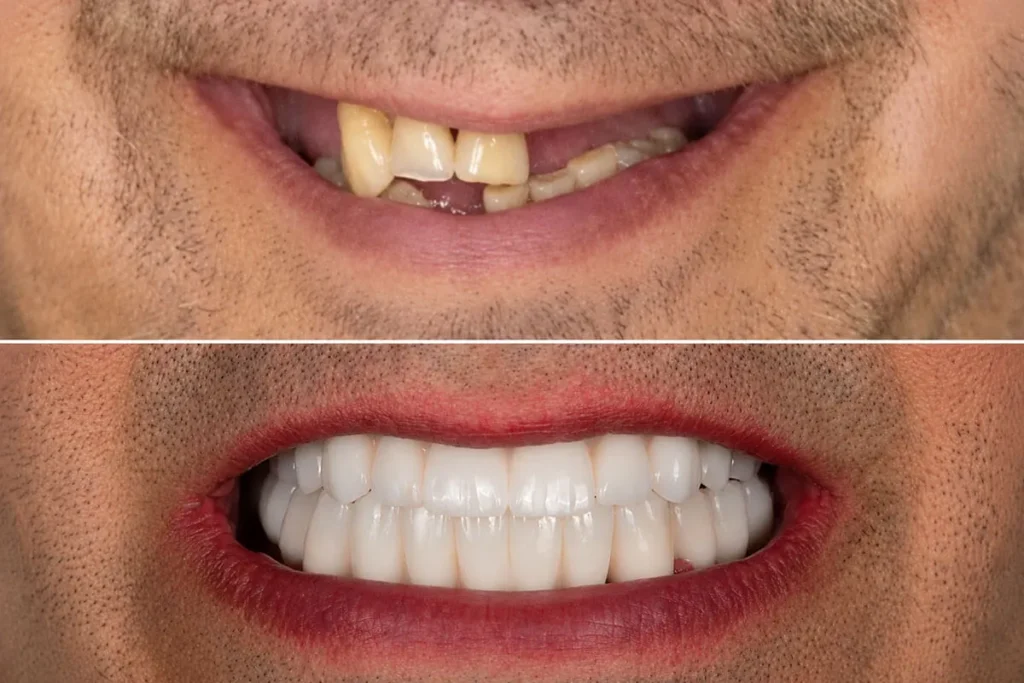 Caz clinic reabilitare dentară completă pe implanturi - Denttaglio