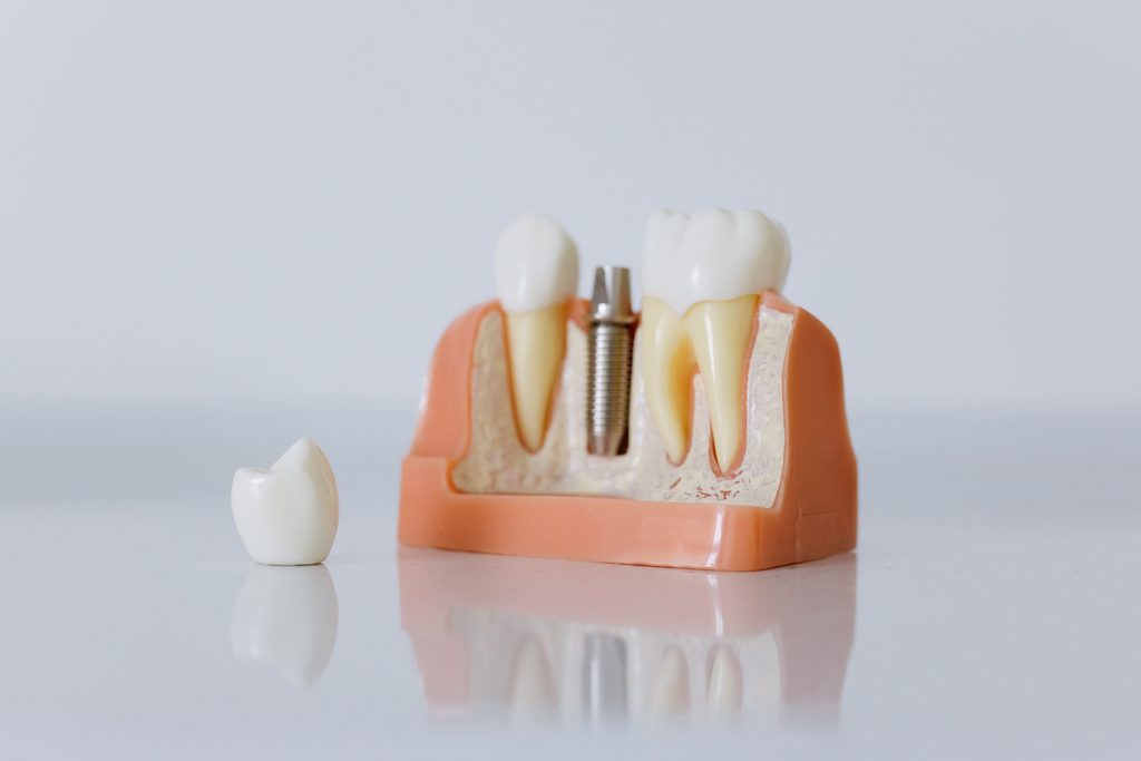coroană pe implant